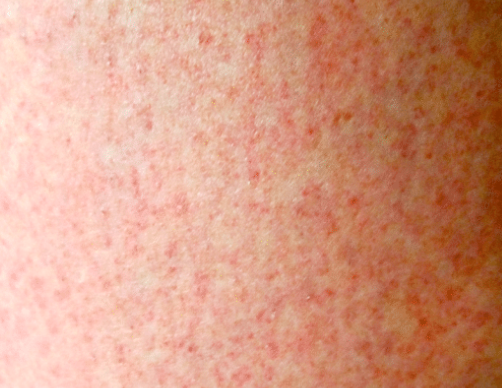 Are These Bumps Razor Burn or Keratosis Pilaris?