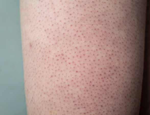 Could Your Dry, Bumpy 'Chicken Skin' be Keratosis Pilaris?