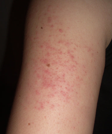 How to Spot Keratosis Pilaris